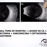 ¿Dónde está el foco? - Enfoftalmitis mixta
