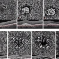 Nuevos OCT-A y su utilidad clínica