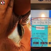 Catarata Traumatica por herida penetrante corneal