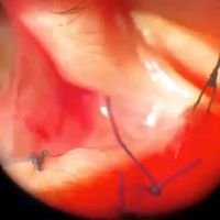 Alternativas en la reconstrucción post traumatica de la via lagrimal