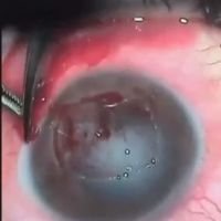 Queratitis por Acanthamoeba + queratectomia profunda