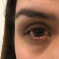 Hidrops Corneal Agudo