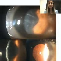 Distrofia reticular TIPO 1 (Biber-Haab-Dimmer)