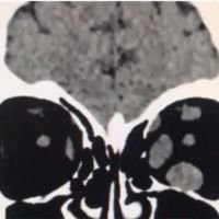 Descompresión Orbitaria