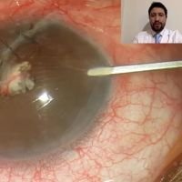Catarata traumática por herida penetrante esclerocorneal
