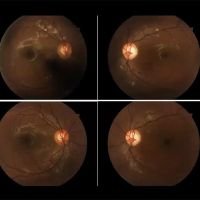 Daño Nervio óptico