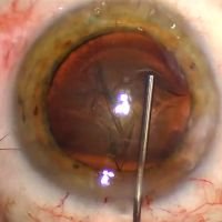 Tip Tok Visco Soft: Manejo de nucleo blando y OVD