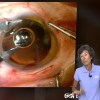 Evolución de las técnicas de extracción de la catarata desde 1917