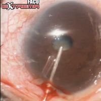 Facoemulsificación en ojos con Cx ocular previa