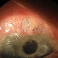 Expansores conjuntivales