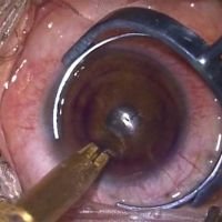 Tunelización superficializada