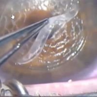 Femtolaser en Córnea