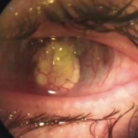 Queratitis Infecciosa en Pandemia