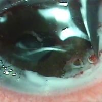 Queratoplastia en caliente