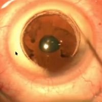 Cornea Remodeling