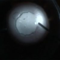 Corneal transilumination