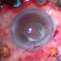 Procedimientos Antero Posteriores