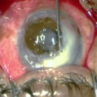 Queratoplastia Tectónica