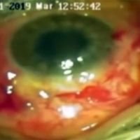 De la Cornea a la Retina