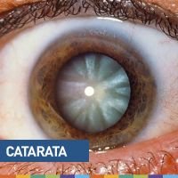 Estudio del paciente con catarata