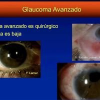 Glaucoma avanzado