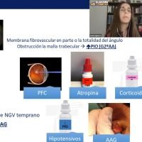 Glaucoma neovascular